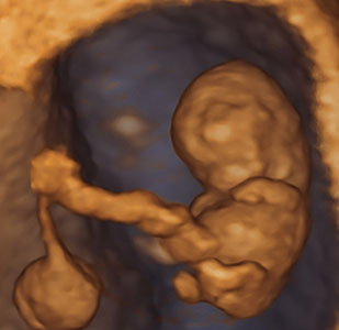 Ultraschallbild eines Babys